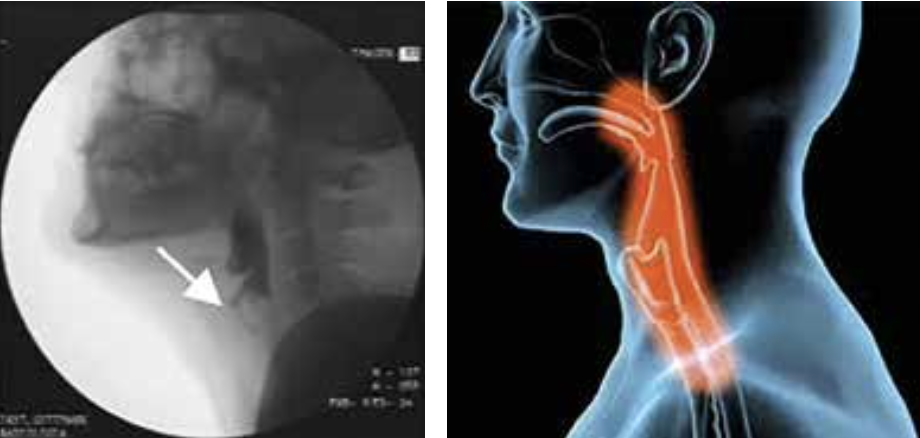 L’aspirazione nella Sindrome di Rett